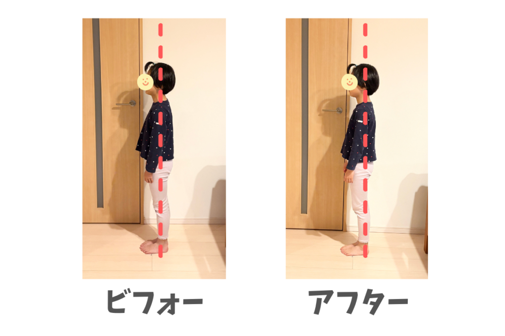 へやスポアシスト　姿勢の変化　小学2年生　立位姿勢